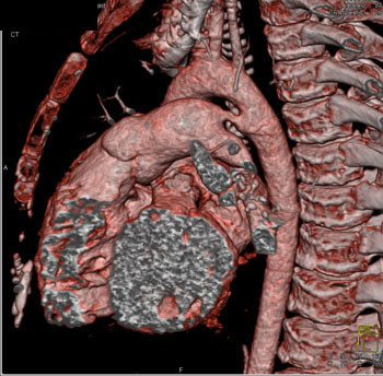 cardiac 64 mdct