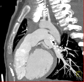 cardiac 64 mdct