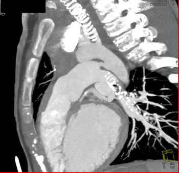 cardiac 64 mdct