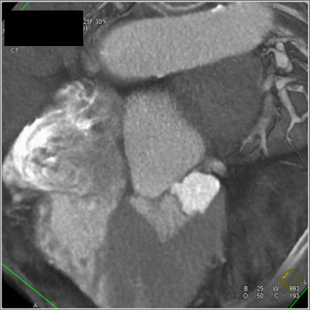 cardiac 64 mdct