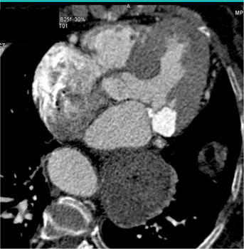 cardiac 64 mdct