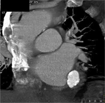 cardiac 64 mdct