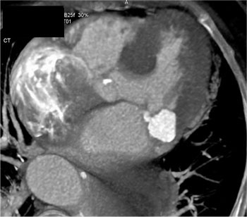 cardiac 64 mdct