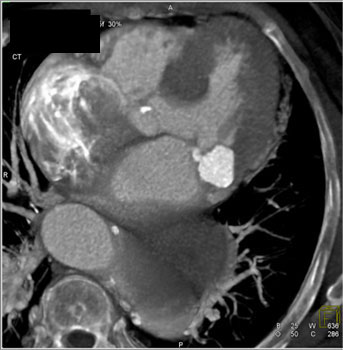 cardiac 64 mdct