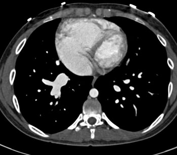 cardiac 64 mdct