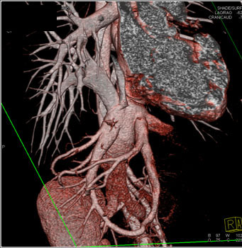 cardiac 64 mdct