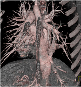 cardiac 64 mdct