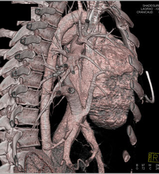 cardiac 64 mdct