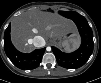 cardiac 64 mdct