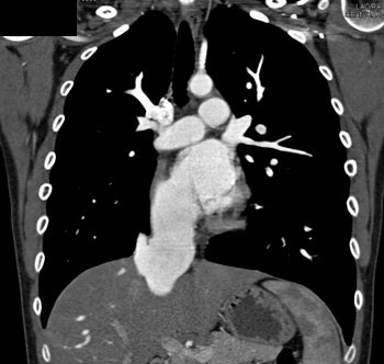 cardiac 64 mdct