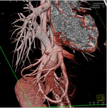 cardiac 64 mdct