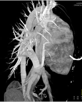 cardiac 64 mdct