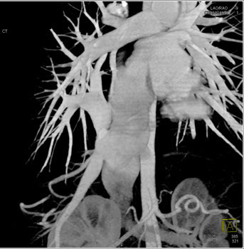 cardiac 64 mdct