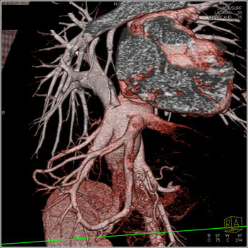 cardiac 64 mdct