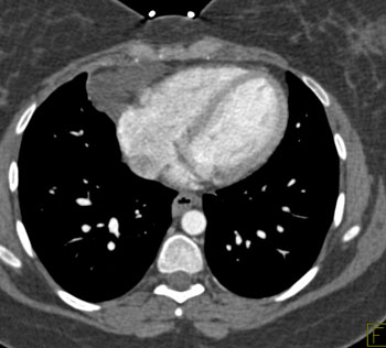 cardiac 64 mdct