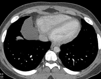 cardiac 64 mdct