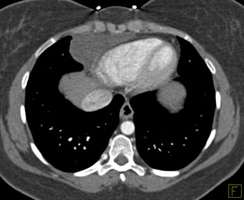 cardiac 64 mdct