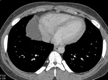 cardiac 64 mdct