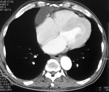 cardiac 64 mdct