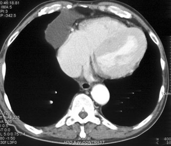 cardiac 64 mdct