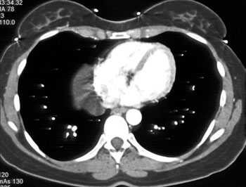 cardiac 64 mdct