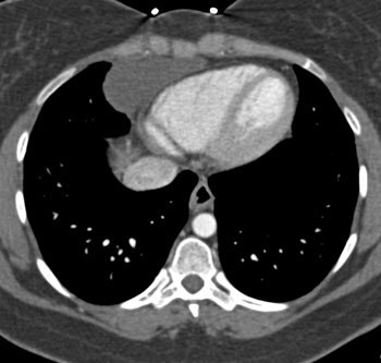 cardiac 64 mdct