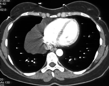 cardiac 64 mdct