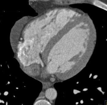 cardiac 64 mdct