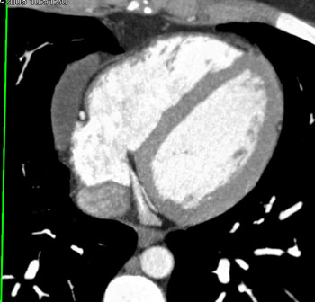 cardiac 64 mdct