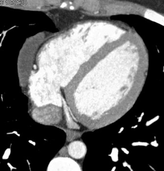 cardiac 64 mdct