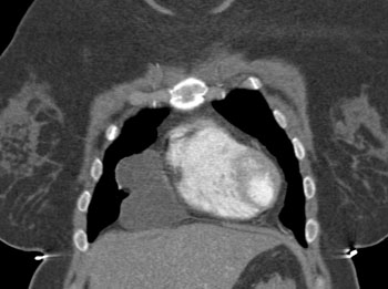 cardiac 64 mdct