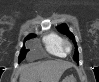 cardiac 64 mdct