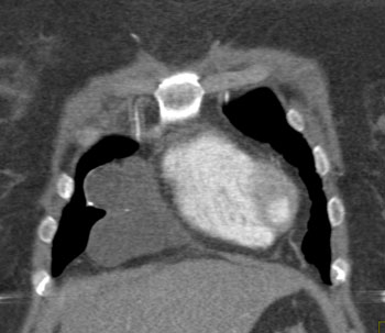 cardiac 64 mdct