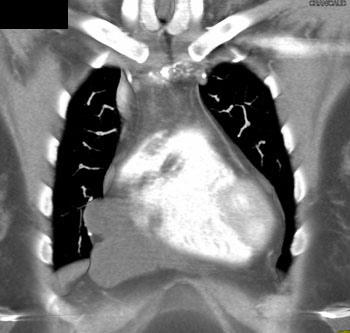 cardiac 64 mdct