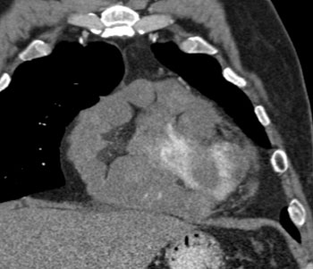 cardiac 64 mdct