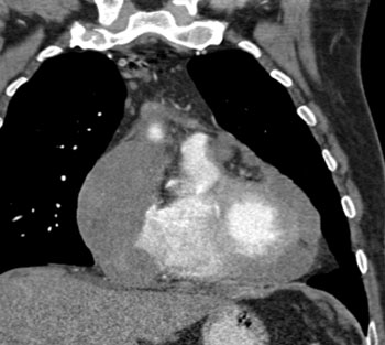 cardiac 64 mdct