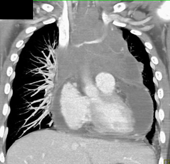 cardiac 64 mdct