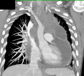 cardiac 64 mdct