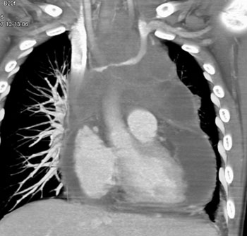 cardiac 64 mdct