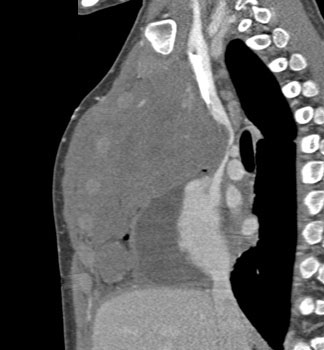 cardiac 64 mdct