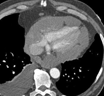 cardiac 64 mdct