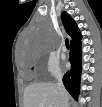 cardiac 64 mdct