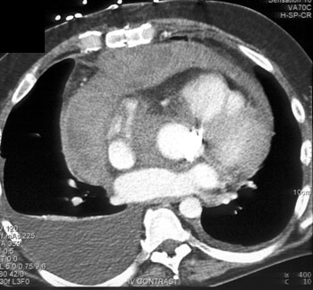 cardiac 64 mdct