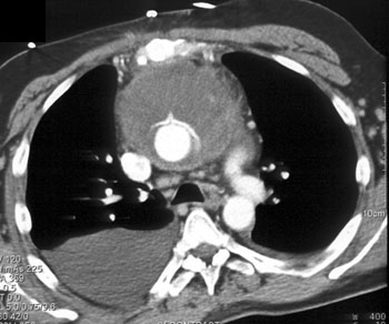 cardiac 64 mdct