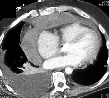 cardiac 64 mdct