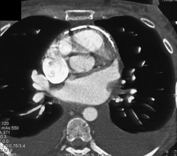 cardiac 64 mdct