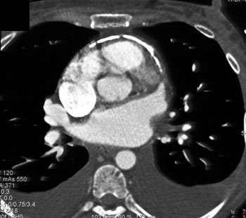 cardiac 64 mdct