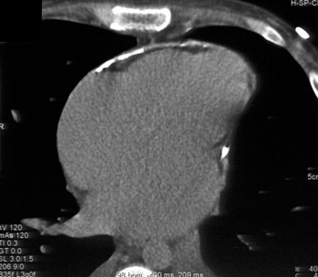 cardiac 64 mdct