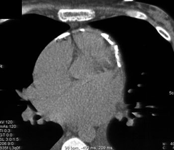 cardiac 64 mdct