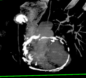 cardiac 64 mdct